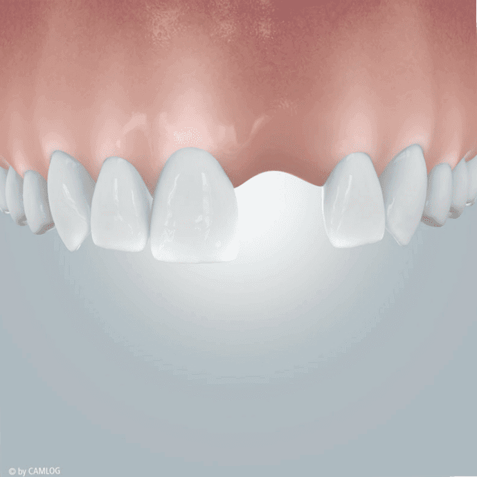Implants as tooth replacement